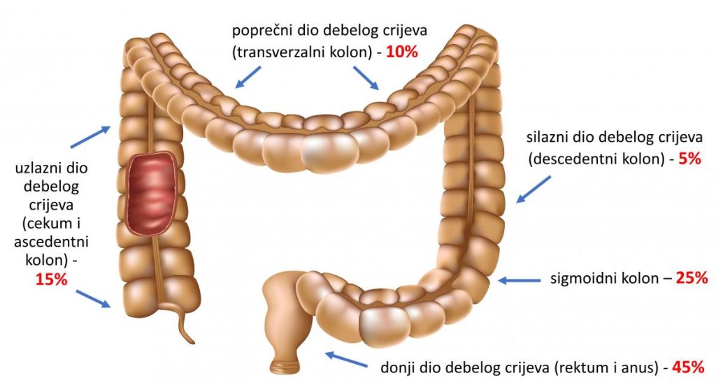 kolorektalni karcinom medicinska ilustracija debelog crijeva