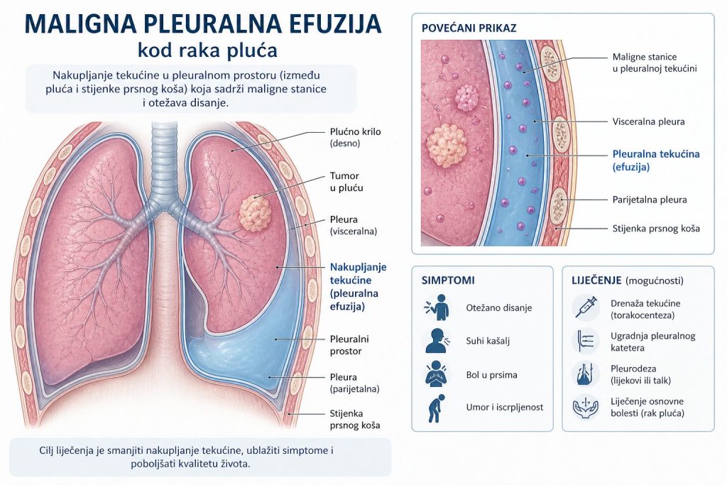 maligna pleuralna efuzija rak pluća ilustracija