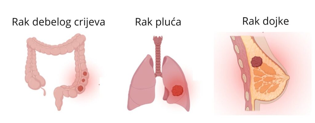 Najčešći tipovi raka u istraživanjima: rak dojke, rak pluća i rak debelog crijeva"